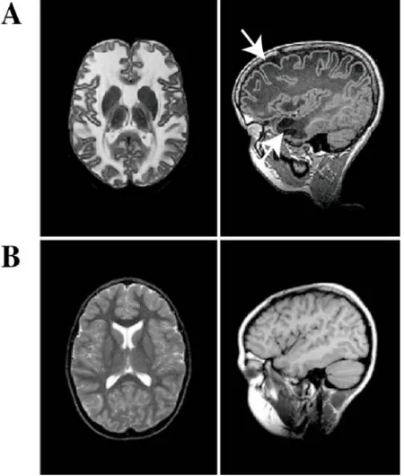 Figura 1. Imágenes de MRI correspondientes a un paciente de MLC y a un control. (A) MRI 