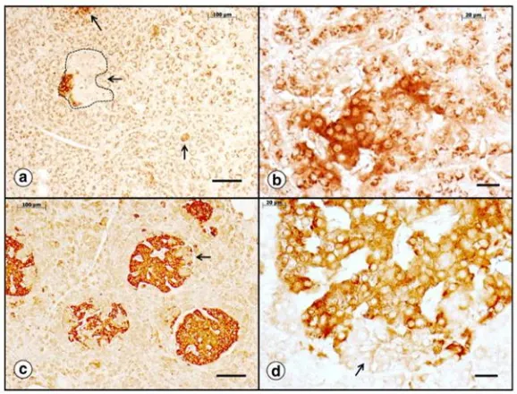 Figura 8. El pàncrees endocrí en l’FRDA. (a)–(b) Pacient diabètic; mostren les invaginacions del pàncrees exocrí normal dins de les illes que són negatives per la tinció amb sinaptofisina però diferents a la resta de teixit no reactiu