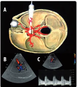 Figura 8: (A) Imagen representativa de la aplicación de ultrasoni-dos para la evaluación de las arterias intracraneales