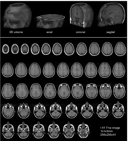 Figure 1.3: Brain MRI representation. The ﬁrst row illustrates the 3D volume and its3 diﬀerent orientations (axial, coronal, and sagital respectively from left to right)