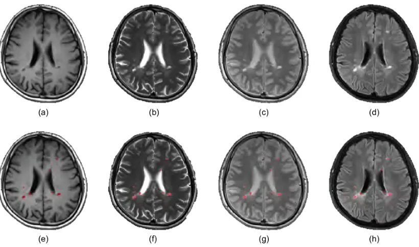 Figure 2.6: 3T MRI of a MS patient: (a) T1w, (b) T2w, (c) PD, and (e) FLAIR. Thesecond row shows the same images as above with the lesion mask overlaid in red.