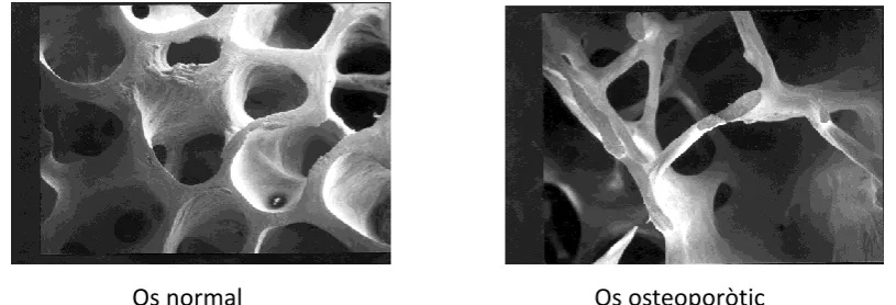 Figura 8. Canvis estructurals com a conseqüència de la pèrdua d'os esponjós. 