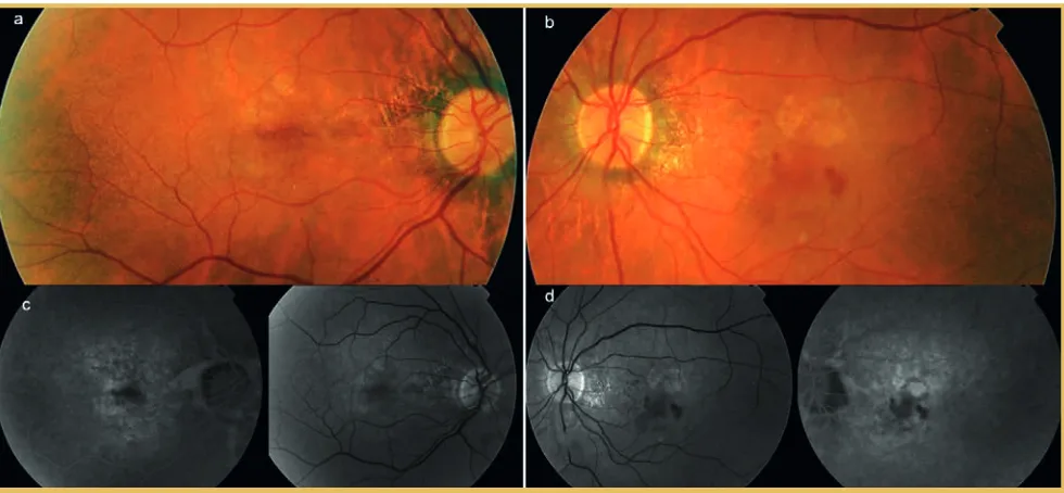 Figura 13. Retinografia i angiografia de la pacient de la Figura 12 que va desenvolupar una membrana neovascular retiniana secundària a les estries angioides.