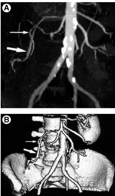 Figure 2. STS-MIP image (l5 mm thick) shows multiple dilated ves-also early ﬁlling of ileocolic vein (arrowhead), simultaneous to thesels within the right colonic wall (arrows), diagnostic of AGD