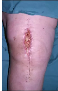 Figura 7. Necrosis de la herida quirúrgica en ATR 