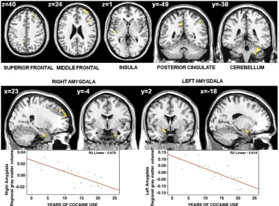 Fig. 2. The related mean-centered volume of the bilateral amygdala with the years of cocaine abuse variable and other region-related volumes
