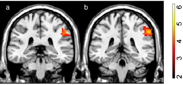 Fig. 1 –zRight is right. White labels (top) indicate the Main activation in the 2-back condition in both groups (p<0.0001, uncorrected; activation cluster size threshold (k)=16)