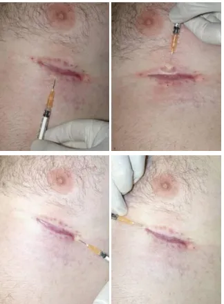 Figura 3.2: Inyección del contraste en la cicatriz del melanoma  