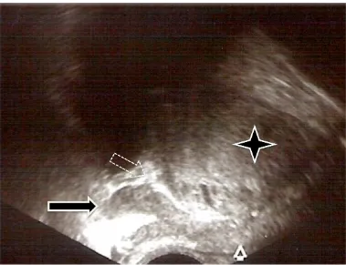 Figura 9. Visión ecográﬁca de un plano sagital oblicuo de las vesículas seminales. Estrella de 4 puntas: próstata, ﬂecha negra: vesículas seminales; ﬂecha hueca: ángulo vesículo-prostático superior