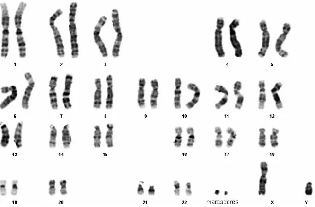 Fig.30. Metafase del paciente con 48,XY,+mar1,+mar2 en la que se 