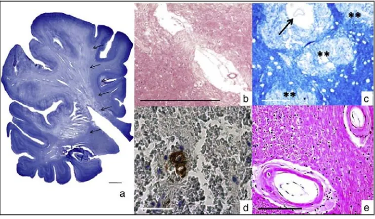 Fig. 2.  Algunos de los principales cambios patológicos subyacentes en la DV. 