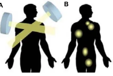 Figura 6. Representació esquemàtica dels tractaments oncològics amb (A) radioteràpia i (B) radiofàrmacs 