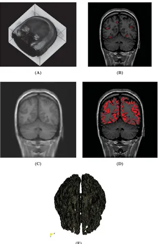 Fig. 12Segmentation of gray matter using region growing algorithm.growing region.selection of ¯ve initial seeds