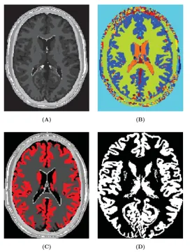 Fig. 15Gray matter segmentation in brain phantom. (A) Axial slice number 98 of an original phantom image