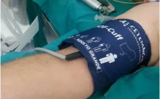 Figura 14. Manguito TOF-Cuff colocado en brazo derecho según las indicaciones de la zona arterial y zona de plexo nervioso
