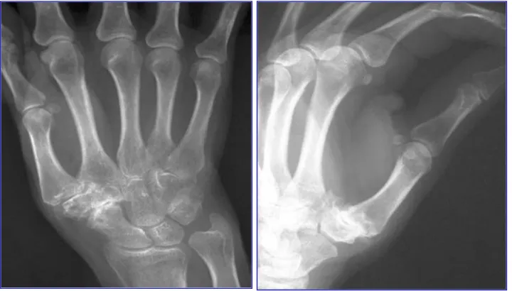 Fig 6. Imagen radiológica de la artrosis TMC. 