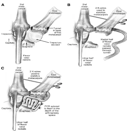 Fig 8A.  Técnica quirúrgica de trapeciectomía con interposición tendinosa. Tras trapeciectomía, se tuneliza la base del primer metacarpiano (A); con hemitendón de FCR se reconstruye primero el ligamento intermetacarpiano (B) y posteriormente se protege con