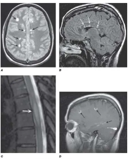 Figura 2.4 Signos de MS detectados por MRI. 