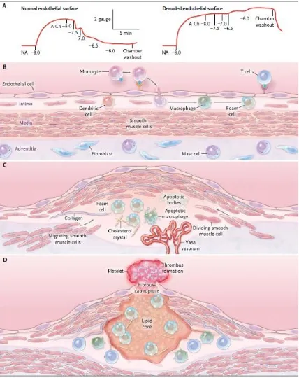 Figura 1. Fases en el desenvolupament de l’arteriosclerosi. 