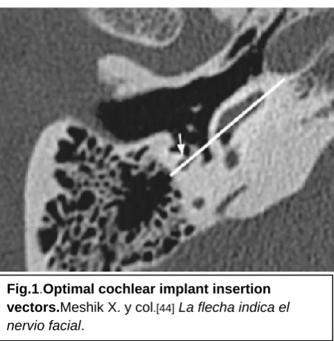 Fig.1.vectors.Optimal cochlear implant insertion Meshik X. y col La flecha indica el 