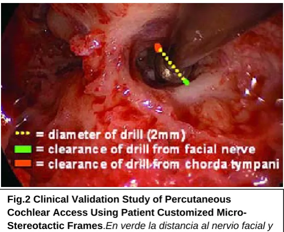 Fig.2 Clinical Validation Study of Percutaneous Cochlear Access Using Patient Customized Micro-