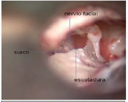 Fig.4 La situación del yunque protege el NF 
