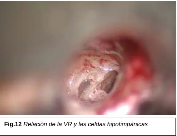 Fig.12 Relación de la VR y las celdas hipotimpánicas 