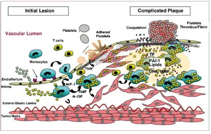 Figura 3: Representació esquemàtica de la progressió de la placa ateroscleròtica des de les etapes inicials de la disfunció endotelial a estadis estimulant de colònies de macròfags; MCP-1: proteïna quimiotàctica de monòcits 1; MMP: metaloproteïnases; PAI-1