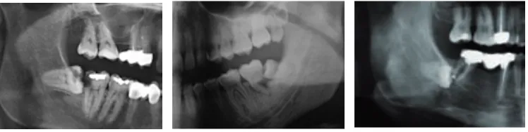 Figura 11. Caries coronaria o radicular y reabsorción de la raíz distal del segundo molar debida a la impactación del tercer molar.