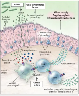 Figura 1.2: Interacció del gluten amb els factors genètics, ambientals i immunològics a la malaltia celíaca: propria, where it is deamidated by tissue transglutamin-ase, allowing interaction with HLA-DQ2 (or HLA-DQ8) on the surface of antigen-presenting ce