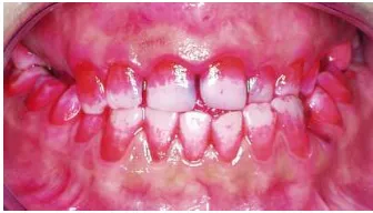 Figura V.1. Tinción de los dientes con el revelador de placa bacteriana (Plac-control®), para 