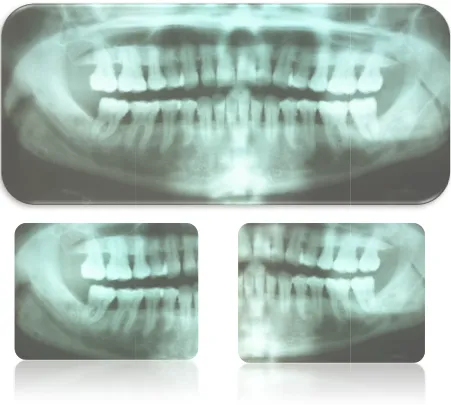 Figura II. 1. Ortopantomografía y Ortopantomografía y detalles, de lesiones osteolíticas en pacientes con mieloma detalles, de lesiones osteolíticas en pacientes con mieloma 