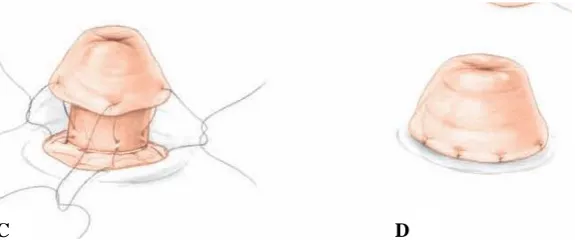 Fig 4. A. Ileostomía continente 