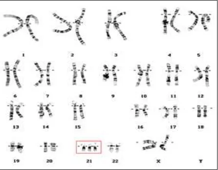 Figura 1. Cariotipo de una niña con síndrome de Down, se aprecian 3 copias del cromosoma 21