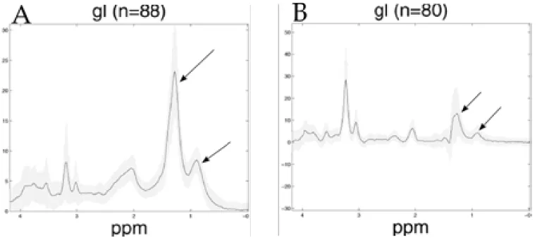 Figura 1.11: Espectres promig de glioblastoma obtinguts de la base de dades INTER-PRET (http://azizu.uab.es/INTERPRET/) i Julià-Sapé i col· laboradors (Julià-Sapéet al., 2006)