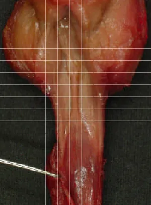 Fig. 1.Relleus de la llum de la uretraprostàtica