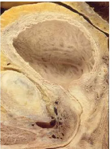 Fig. 2. Tall sagital de la uretra prostàtica