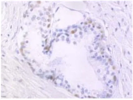 Fig. 9. Carcinoma de pròstata amb positivitat intensa i difusa per a p53 en una zona amb un 