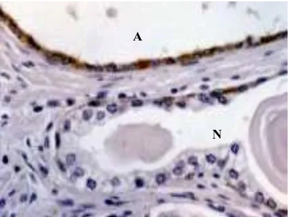Fig. 32.. Intensa expressió de CatS a una zonade metaplàsia transicional (M), amb epitelinormal adjacent negatiu (N)