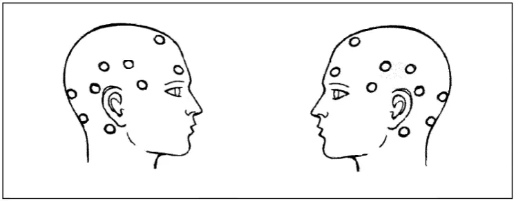 Figura 3.1. Exploració dels punts cranials dolorosos del costat dret i esquerre. 