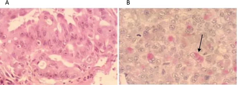 Fig. 2. En A es pot observar un adenocarcinoma moderadament diferenciat on s’aprecien les glàndules 