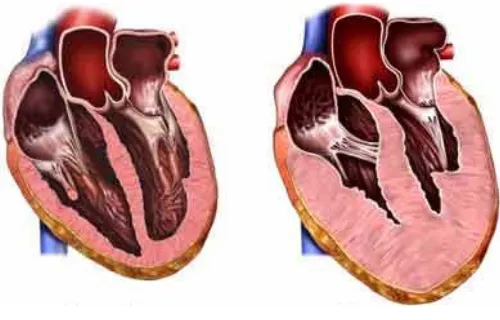 Figura 2. Cor normal (esquerra) i cor hipertrofiat (dreta). 