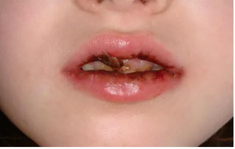 Figura 4. Afectació de la mucosa oral 