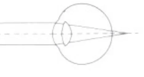 Figura 15.  Curso de los rayos en el ojo hipermétrope sin acomodación. (Hollwich, 1.988)