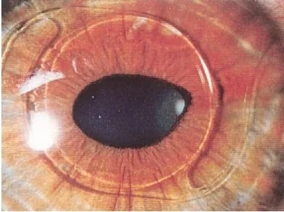 Figura 27. Ovalización pupilar tras 2 años de la implantación protésica intraocular.  