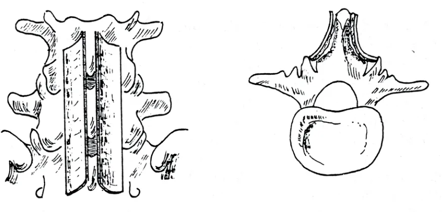 Fig. 1.2.  Atrodesis interlaminar. Injerto osteoperióstico tibial, paraespinoso e interlaminar (Delagenière-Vilardell)