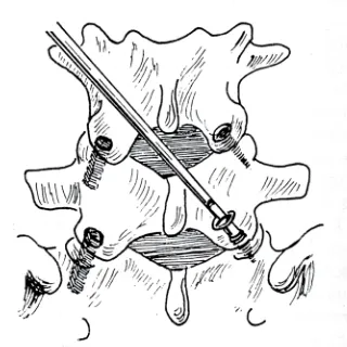Fig. 1.3. Artrodesis interarticular. A la izquierda, empotramiento de taco óseo  (técnica de McBride); a la derecha, fijación con tornillos (técnica de King)