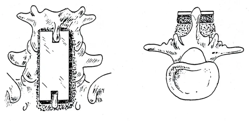 Fig. 1.5. Artrodesis combinadas: técnica de Hibbs. Cruentación extra e intrarticular con imbricación de las virutas óseas y colocación de un taco óseo intrarticular