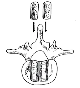 Fig. 1.6. Técnica de Barnes: exéresis parcial o total del arco vertebral posterior.  Colocación de cilindro óseo en el lecho labrado en el espacio intervertebral