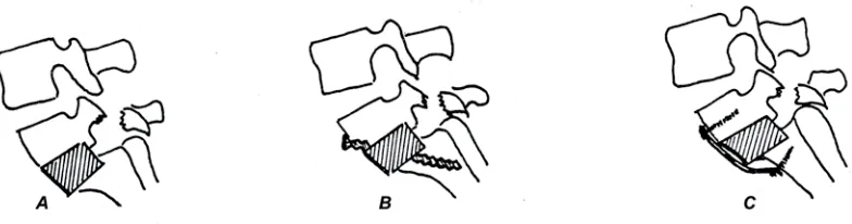 Fig. 1.7. Técnicas de artrodesis anterior  por transfixión . A. Burns; B. Creysel;   C